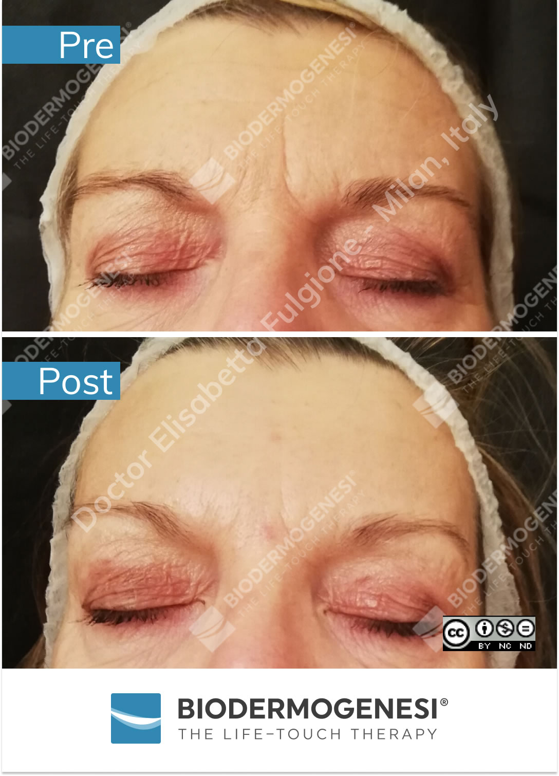 Trattamento AntiAging