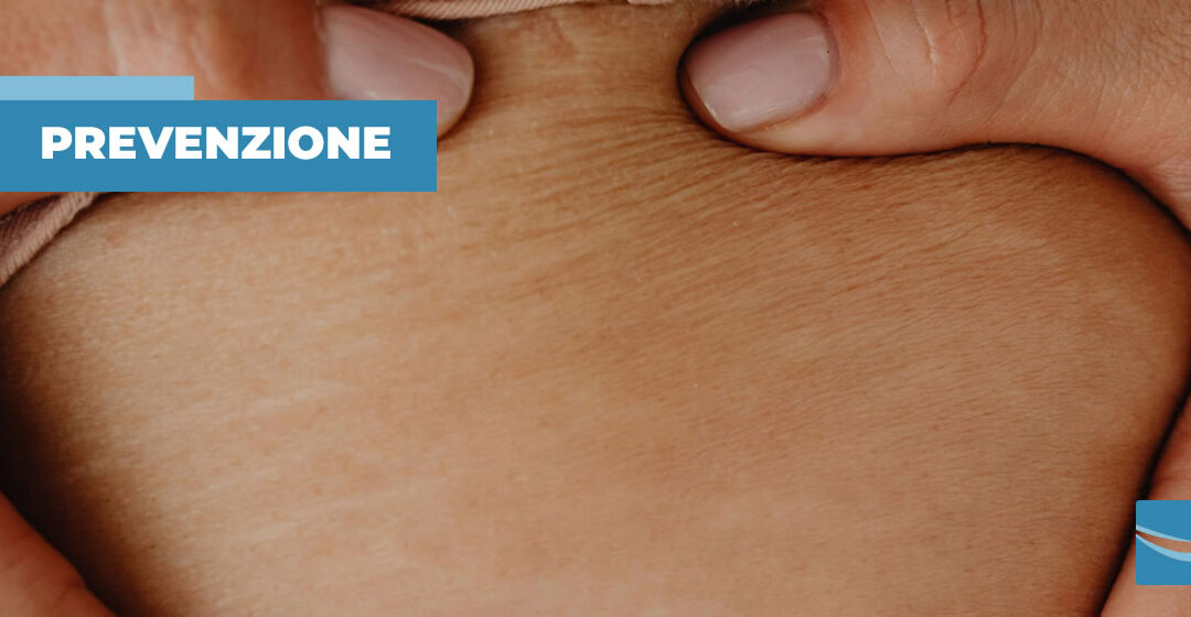 Si possono prevenire le smagliature?