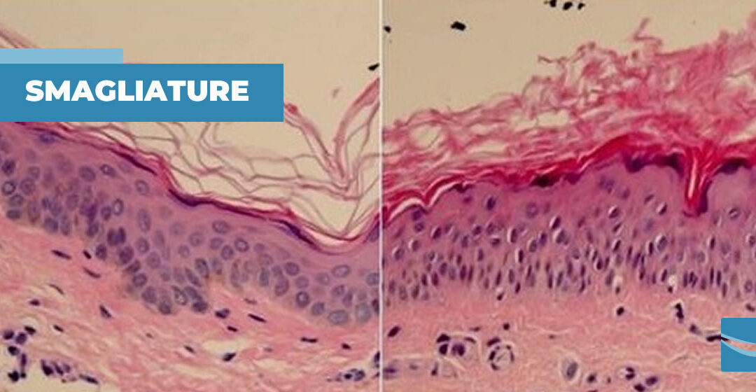 Cosa sono le smagliature