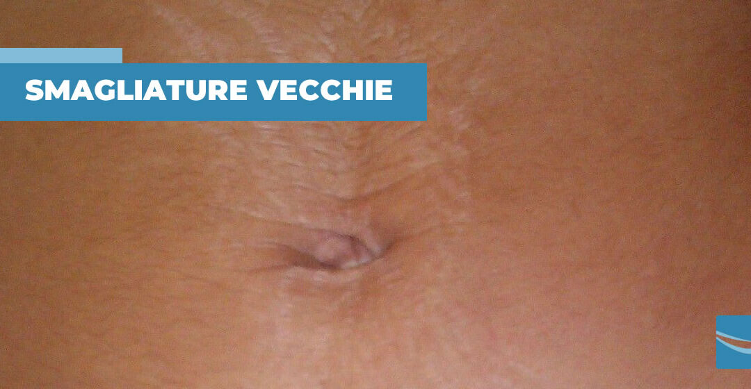 Come curare le smagliature vecchie, bianche e madreperlacee